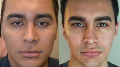 Badem Göz Dolgusu ameliyatı zararlı mı?