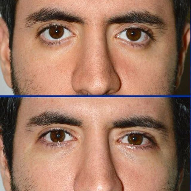 Badem Göz Dolgusu ameliyatı zararlı mı? badem goz ameliyati erkek yorumlari - Badem Göz Dolgusu ameliyatı zararlı mı?