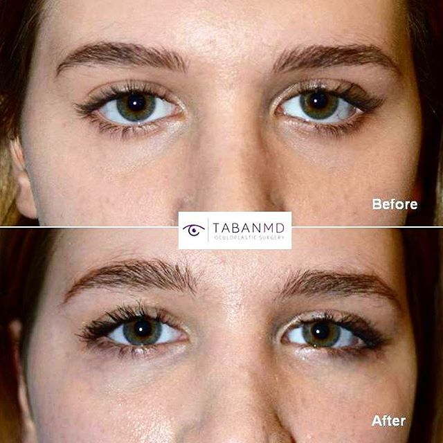 Badem Göz Dolgusu ameliyatı zararlı mı? badem goz ameliyati oncesi ve sonrasi - Badem Göz Dolgusu ameliyatı zararlı mı?